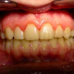 Ortodonta Tczew - apart - widok po leczeniu