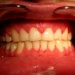 Ortodonta Tczew - apart - widok po leczeniu