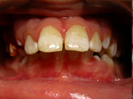 Before